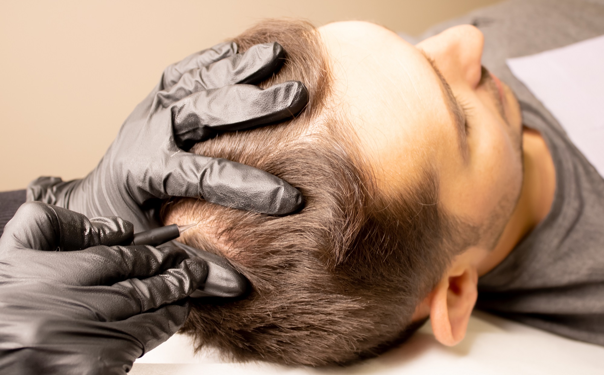 Hair Restoration Treatment Rochester MI - GLO Aesthetics