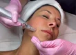 The Transformative Benefits of Regular Microneedling at GLO