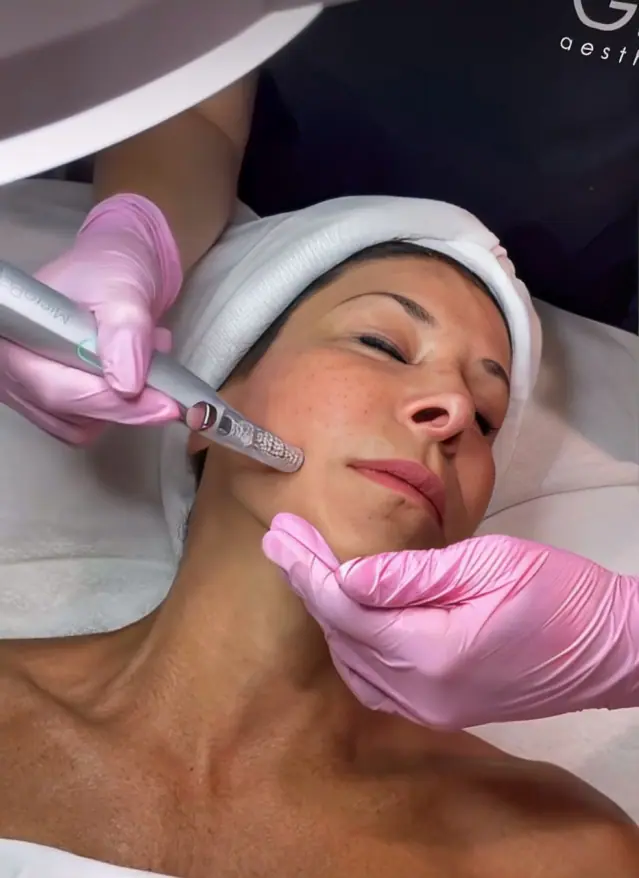 The Transformative Benefits of Regular Microneedling at GLO